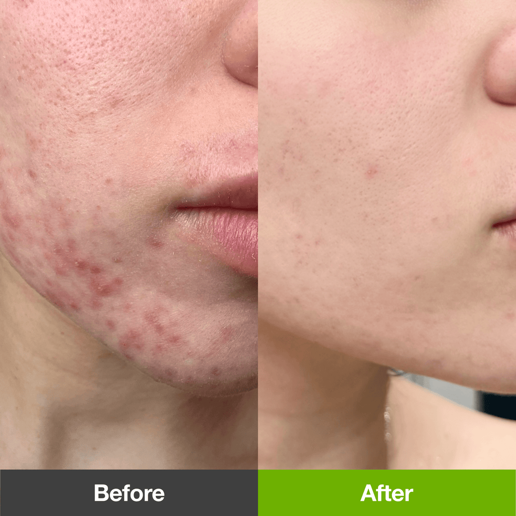 Acne&Dark Spot Care Set