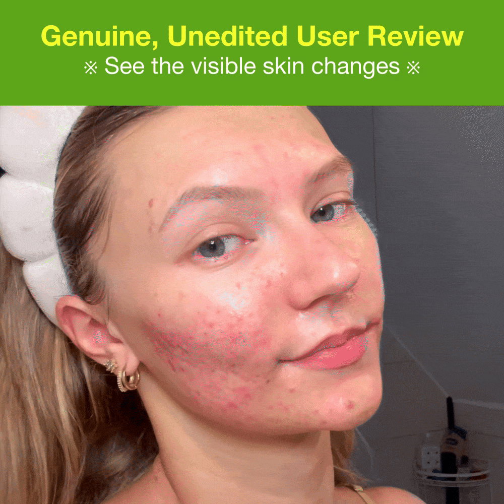 Acne&Dark Spot Care Set